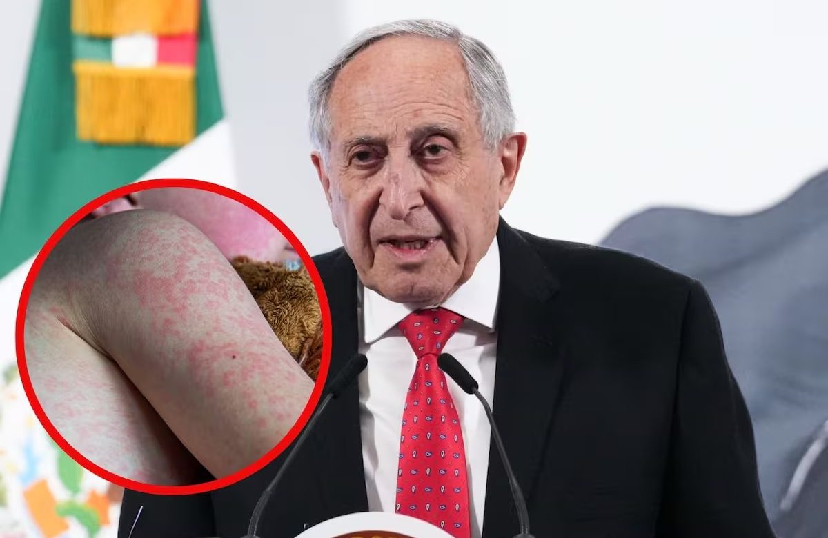 Preocupa aumento de sarampión en México: brote se extiende a 17 estados