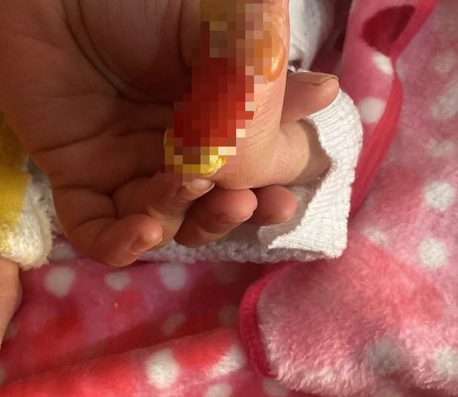 Indignación en Vetagrande: bebé resulta con quemaduras tras prueba médica