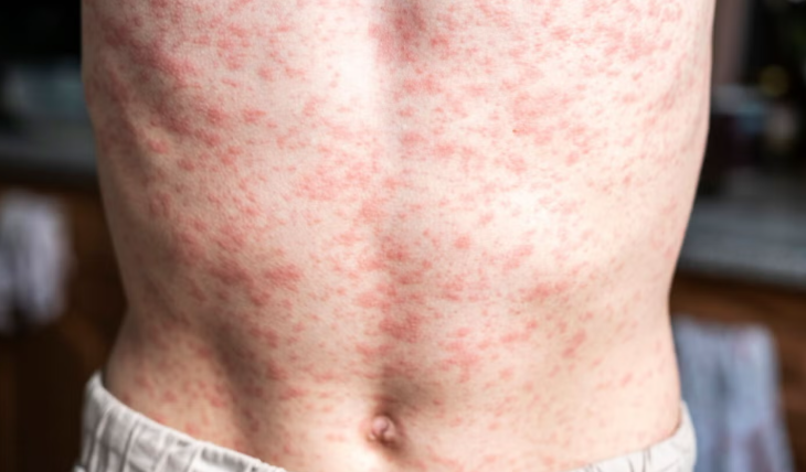 Alerta OPS que continúa brote de sarampión en México